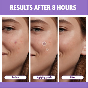 FreeGo Magnesium Acne Patch