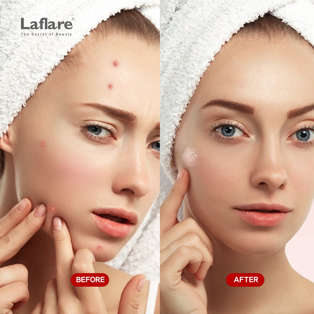 Magnesium Patches for Dark Spots, Blemish. Zit, Acne. Microdart Patches for Face